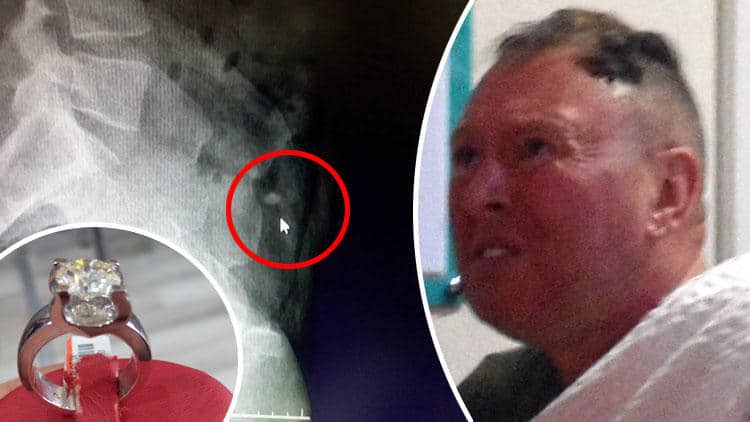 A 54 Year Old Man Swallowed Diamond Ring and The Reason is Just Heartbreaking