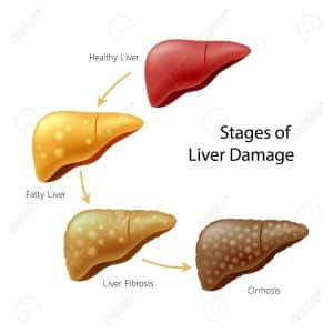 How To Keep Your Liver Healthy?