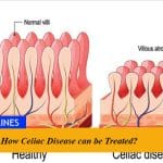 How Celiac Disease can be Treated?